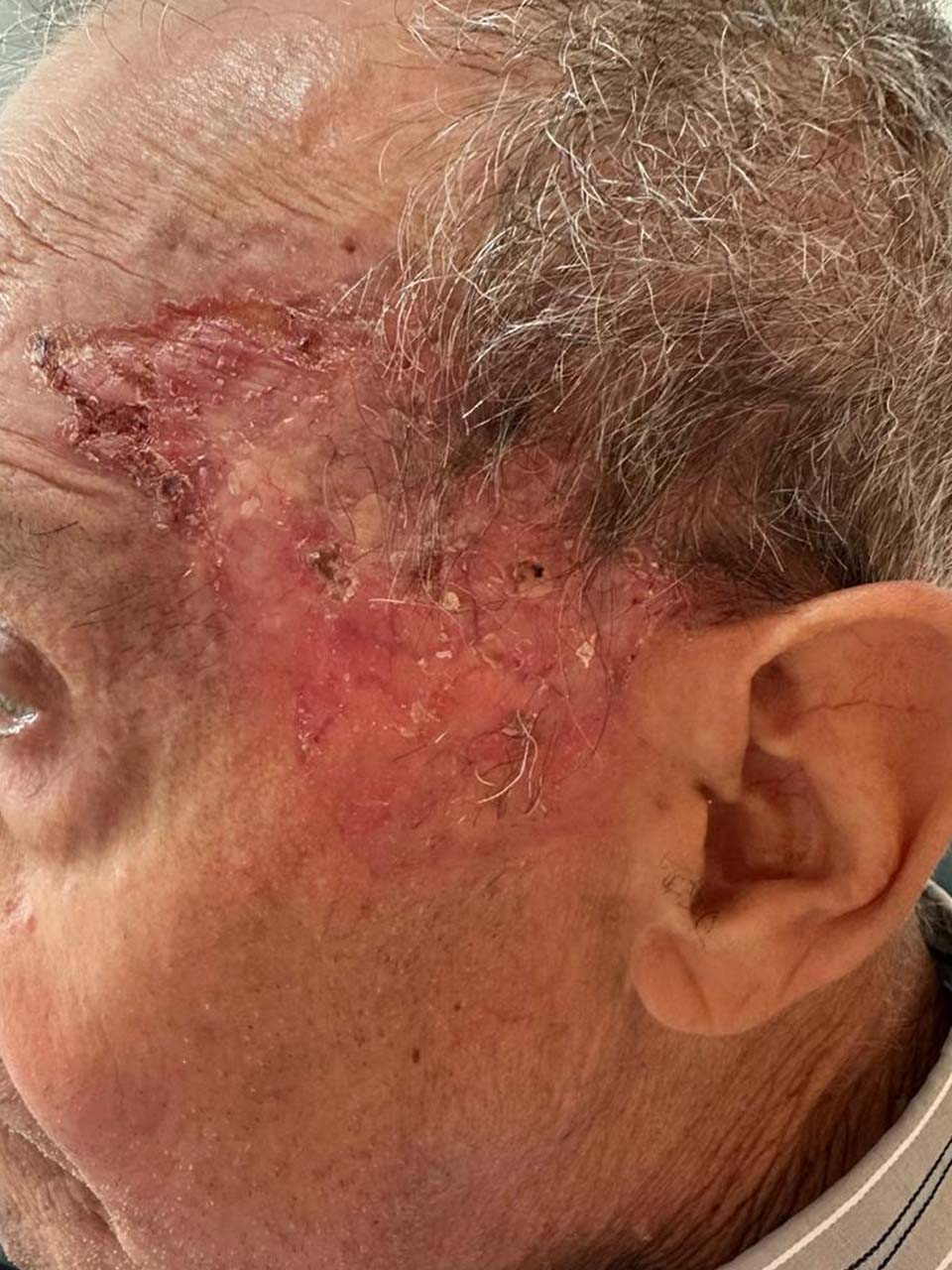 Lesão de pele na face que não cicatriza, sinal de alerta para câncer de pele