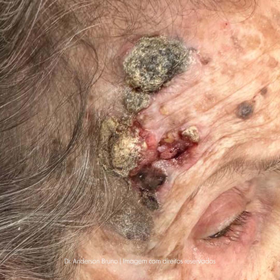 Caso clínico real de doença da cabeça e pescoço