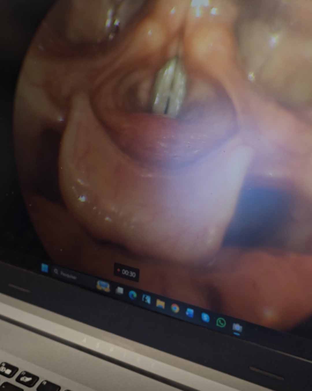 Imagem da laringe e cordas vocais captada durante a videolaringoscopia